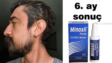 minoxil forte 5 sakal yan etkileri
